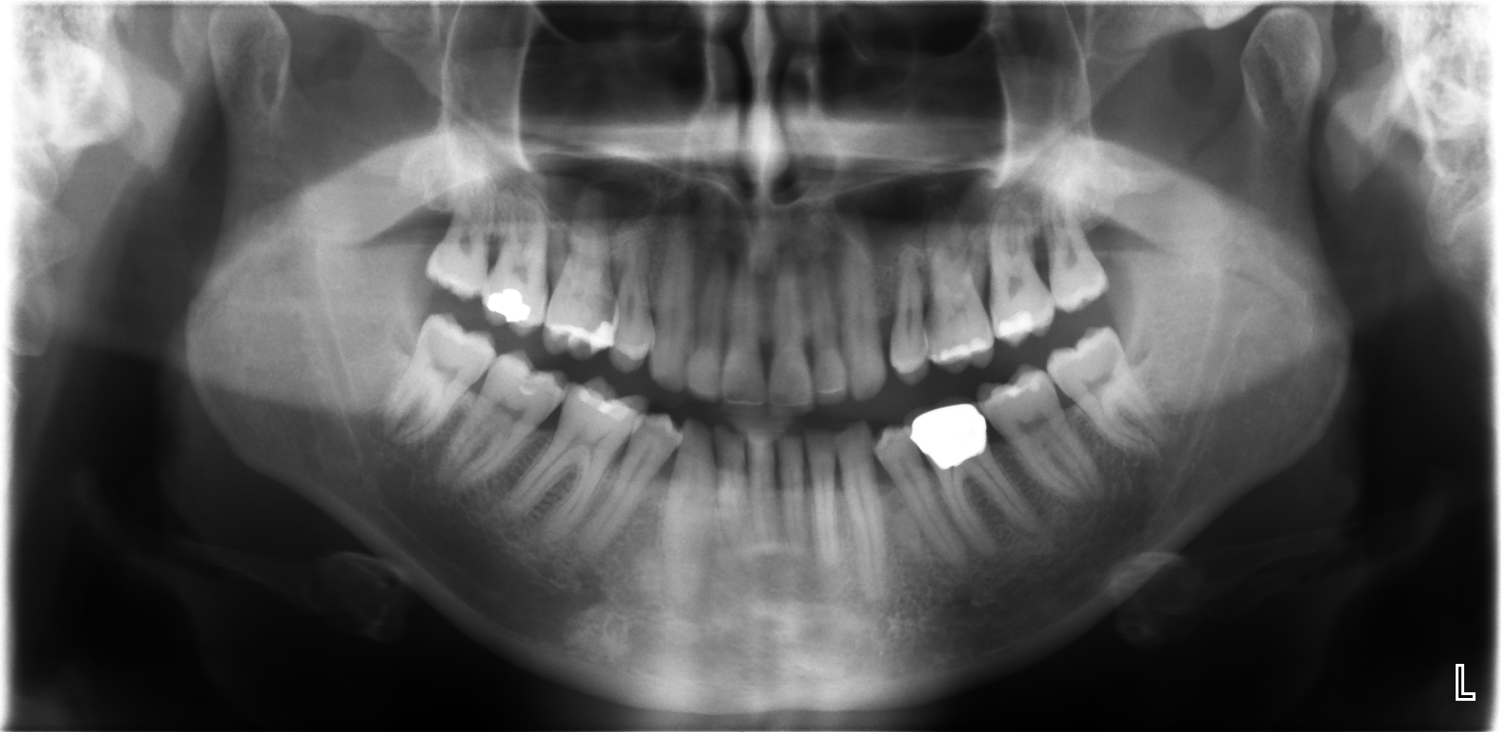 X-RAY - PANARAMIC - 03-05-07